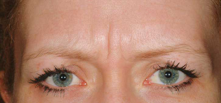 patient1-before