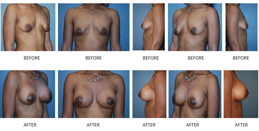 before-after (1)